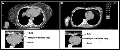 Tangential Field Radiotherapy for Breast Cancer—The Dose to the Heart and Heart Subvolumes: What Structures Must Be Contoured in Future Clinical Trials?